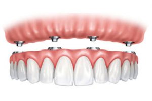 Implantes Dentales Carga Inmediata Clinica Rehberger López-Fanjul