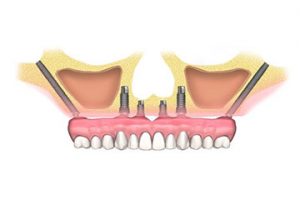 Implantes Zigomáticos Cigomáticos Dentales Clinica Rehberger López-Fanjul