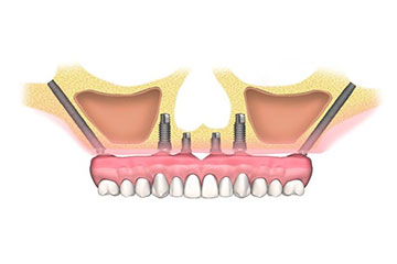 Implantes Zigomáticos Cigomáticos Dentales Clinica Rehberger López-Fanjul