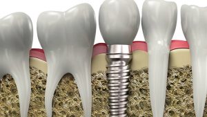 Implantes dentales - Clínica Dental Rehberger - López-Fanjul