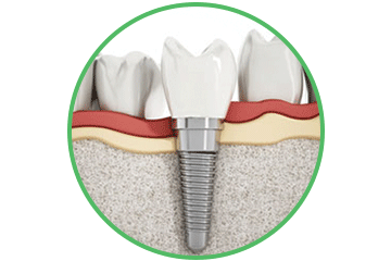 Implantes Dentales Clinica Rehberger López-Fanjul