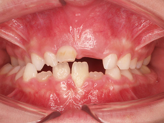 ortodoncia mordida cruzada clínica dental Rehberger López-Fanjul