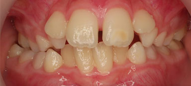 ortodoncia apiñamiento antes clínica dental Rehberger López-Fanjul