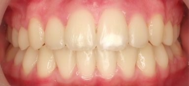 ortodoncia apiñamiento después clínica dental Rehberger López-Fanjul
