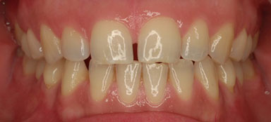 ortodoncia diastemas antes clínica dental Rehberger López-Fanjul