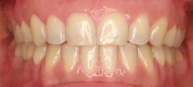 ortodoncia diastemas despues clínica dental Rehberger López-Fanjul