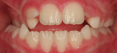 ortodoncia mordida abierta antes clínica dental Rehberger López-Fanjul
