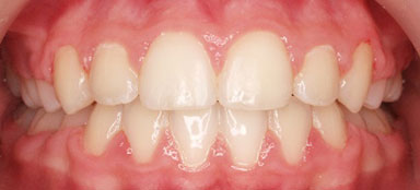 ortodoncia-mordida abierta después clínica dental Rehberger López-Fanjul