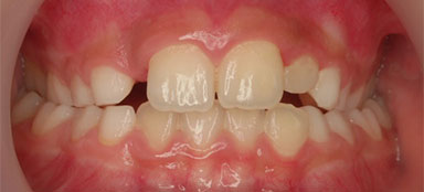 ortodoncia mordida cruzada lateral antes clínica dental Rehberger López-Fanjul