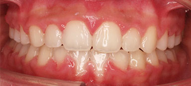 ortodoncia mordida cruzada lateral despues clínica dental Rehberger López-Fanjul