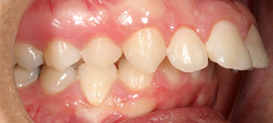 ortodoncia resalte antes clínica dental Rehberger López-Fanjul