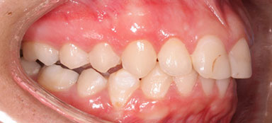 ortodoncia resalte despues clínica dental Rehberger López-Fanjul