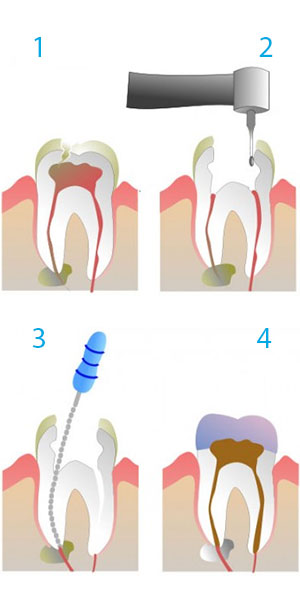 Endodoncia Oviedo Clínica Rehberger López-Fanjul