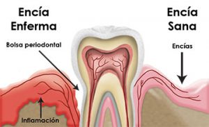 Enfermedad Encias Periodontitis Clínica Rehberger López-Fanjul Oviedo