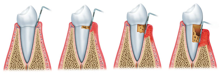 Enfermedad periodontal Clínica Rehberger López-Fanjul Oviedo