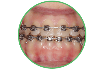 brackets-baja-friccion ortodoncia Clínica Rehberger López-Fanjul Oviedo