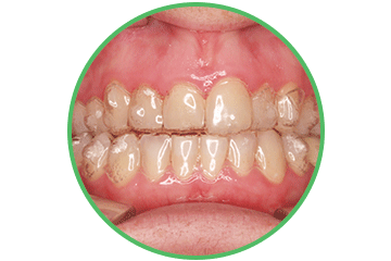 invisalign ortodoncia Clínica Rehberger López-Fanjul Oviedo