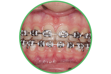 brackets-metalicos ortodoncia Clínica Rehberger López-Fanjul Oviedo