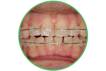 brackets-transparentes ortodoncia Clínica Rehberger López-Fanjul Oviedo