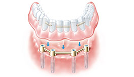 protesis completa sobre implantes dentales Clínica Rehberger López-Fanjul Oviedo