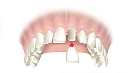 corona dental Clínica Rehberger López-Fanjul Oviedo