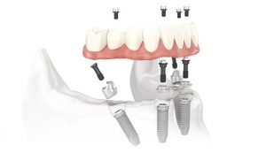 implante dental Clínica Rehberger López-Fanjul Oviedo