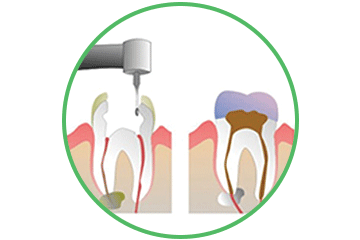 Endodoncia Oviedo Clínica Rehberger López-Fanjul