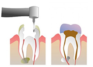 Endodoncia Oviedo Clínica Rehberger López-Fanjul