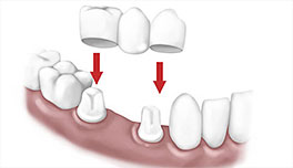 puente dental Clínica Rehberger López-Fanjul Oviedo