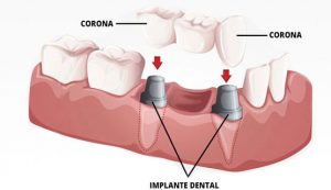puente implante dental Clínica Rehberger López-Fanjul Oviedo