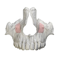 regeneración ósea seno maxilar Clínica Dental y Maxilofacial Rehberger López-Fanjul Oviedo