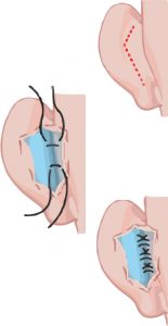 Oreja Otoplastia Cirugía Orejas Clínica Rehberger López-Fanjul Oviedo