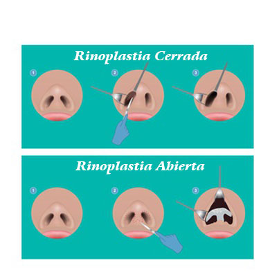 Rinoplastia Abierta y Cerrada Cirugía Nariz Clínica Rehberger López-Fanjul Oviedo