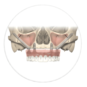 cigomaticos Clínica dental Rehberger López-Fanjul Tu dentista en Oviedo