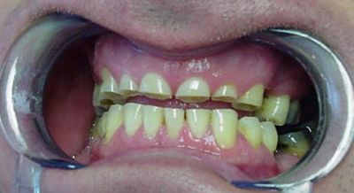 bruxismo desgaste de los dientes