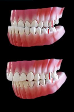 problemas-de-maloclusion-dental