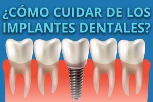 cuidar de los implantes dentales clinica dental rehberger asturias