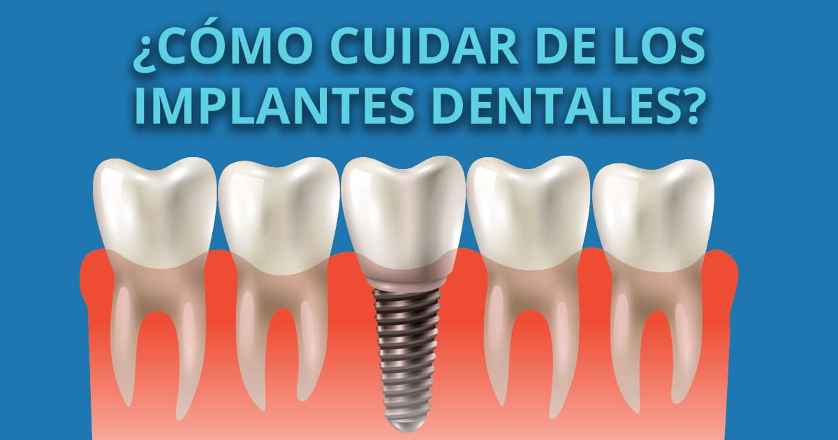 ¿Cuándo es conveniente y cuando no colocar un implante dental?