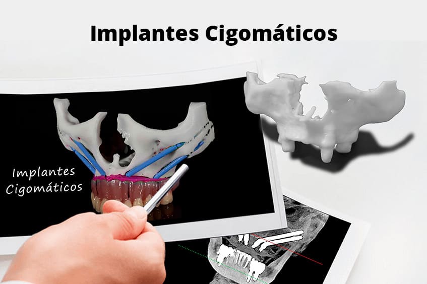 Implantes-cigomaticos-solucion-falta-de-hueso-dentista-maxilofacial-asturias