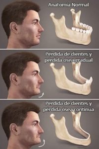 Perdida-de-hueso-por-falta-de-dientes-clinica-dental-maxilofacial-gijon-oviedo-asturias