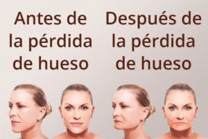 Perdida-de-hueso-por-falta-de-dientes-dentistal-maxilofacial-gijon-oviedo-asturias