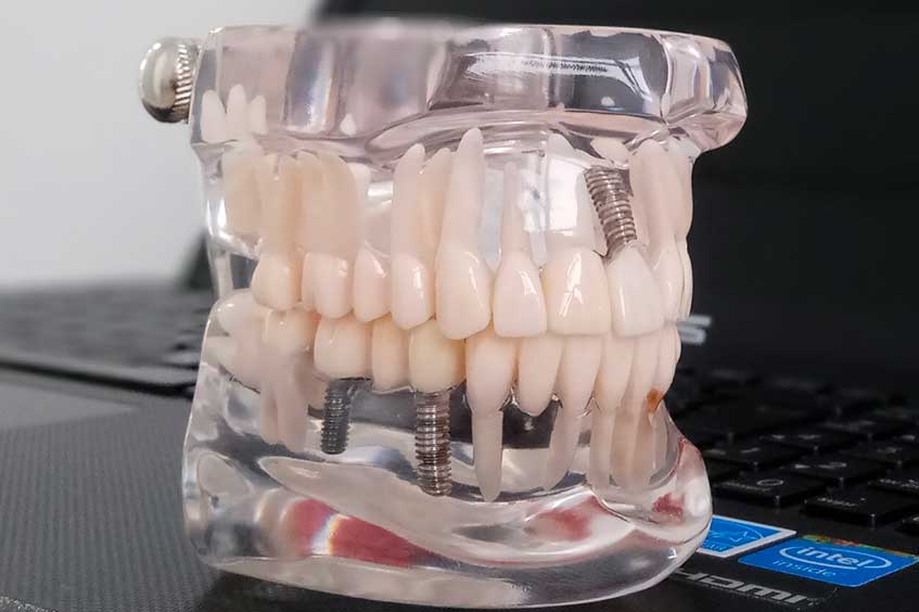 Implantes-dentales-en-asturias