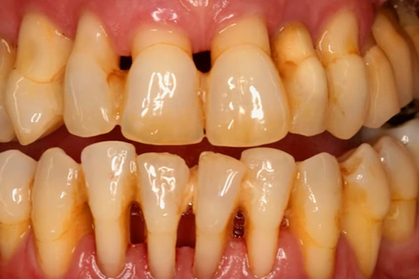 Periodontitis-aguda-perdida-de-dientes-dentista-periodoncia-asturias-gijon-oviedo