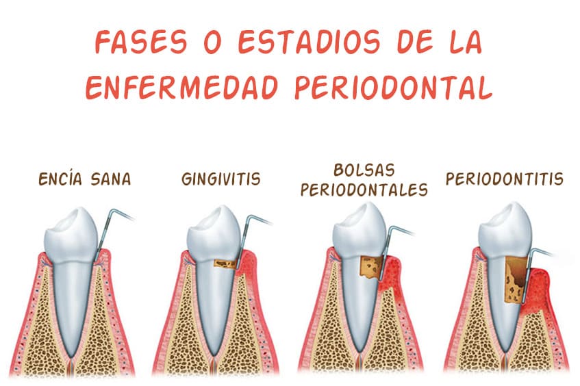 gingivitis-bolsa-periodontal-dentista-periodoncia-asturias-gijon-oviedo