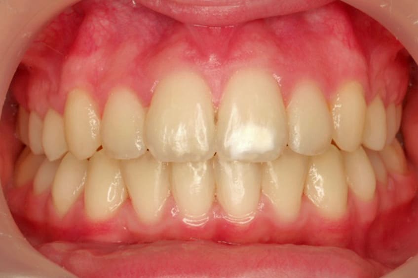 apiñamiento-dental-corregido-ortodoncia-asturias-gijon-oviedo