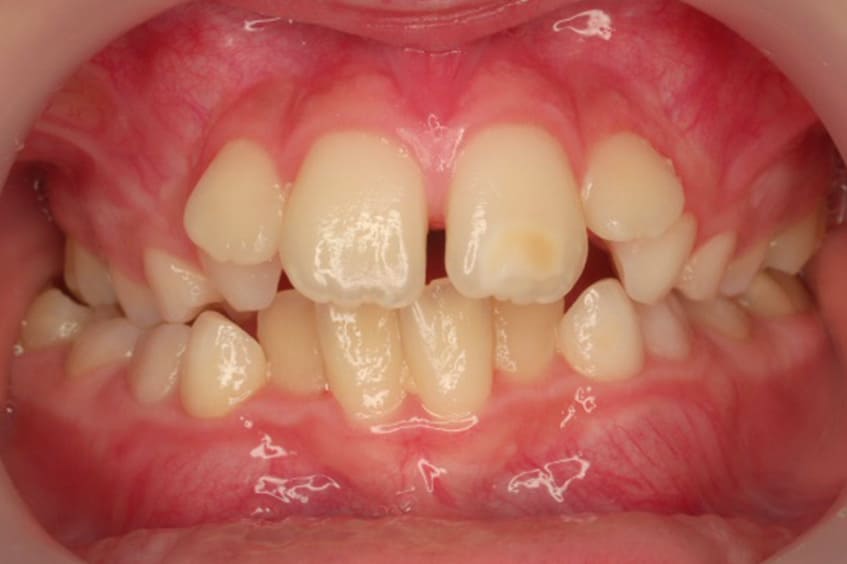apiñamiento-dental-ortodoncia-asturias-gijon-oviedo