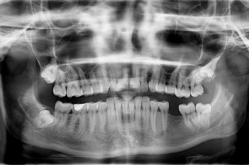 radiografia-dental-implantes-asturias