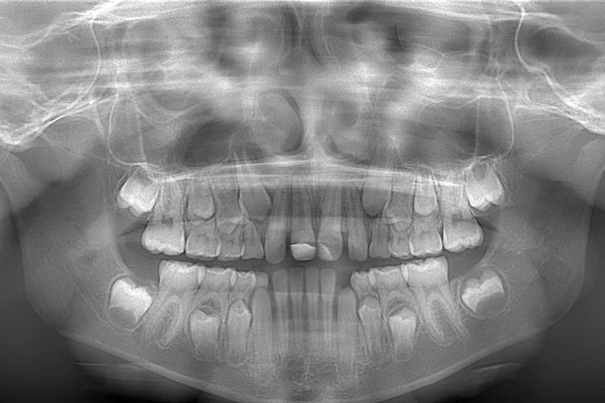 radiografia-reconstruccion-dental-rotura-de-dientes-dentista-oviedo-asturias-gijon
