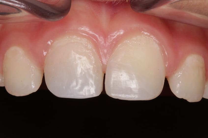 reconstruccion-corona-dental-tras-un-traumatismo-con-fractura-de-los-dientes