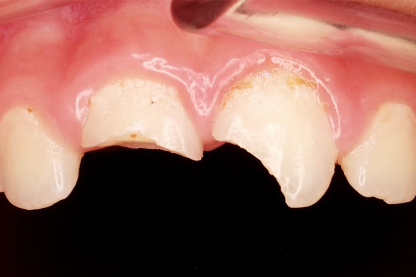 traumatismo-dental-con-fractura-de-los-dientes-clinica-dental-asturias-oviedo-gijon